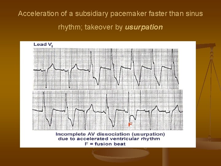 Acceleration of a subsidiary pacemaker faster than sinus rhythm; takeover by usurpation 