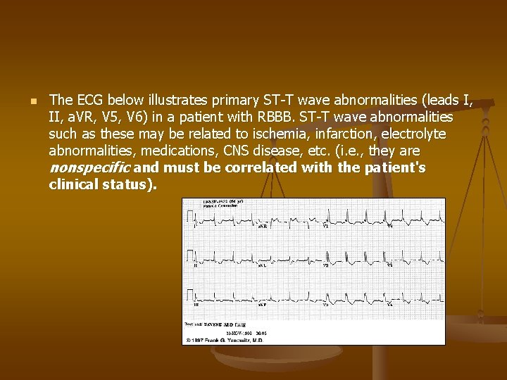 n The ECG below illustrates primary ST-T wave abnormalities (leads I, II, a. VR,