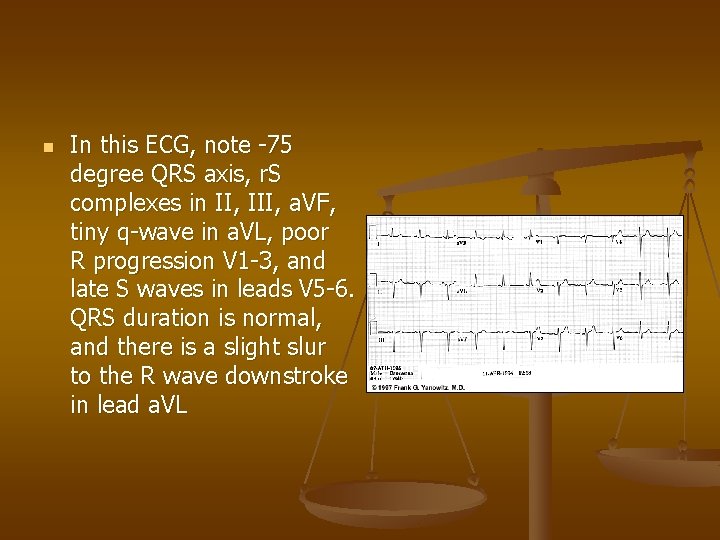 n In this ECG, note -75 degree QRS axis, r. S complexes in II,