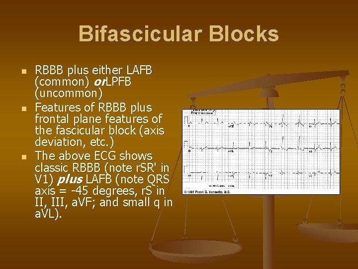 Bifascicular Blocks n n n RBBB plus either LAFB (common) or. LPFB (uncommon) Features