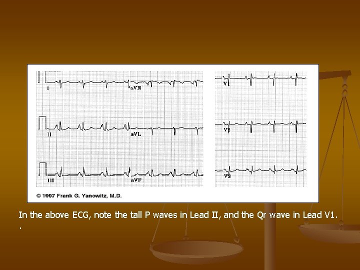 In the above ECG, note the tall P waves in Lead II, and the