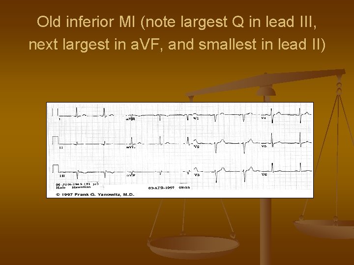 Old inferior MI (note largest Q in lead III, next largest in a. VF,