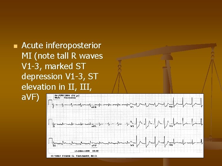 n Acute inferoposterior MI (note tall R waves V 1 -3, marked ST depression
