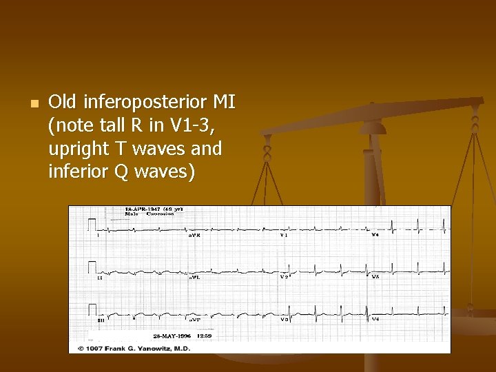 n Old inferoposterior MI (note tall R in V 1 -3, upright T waves