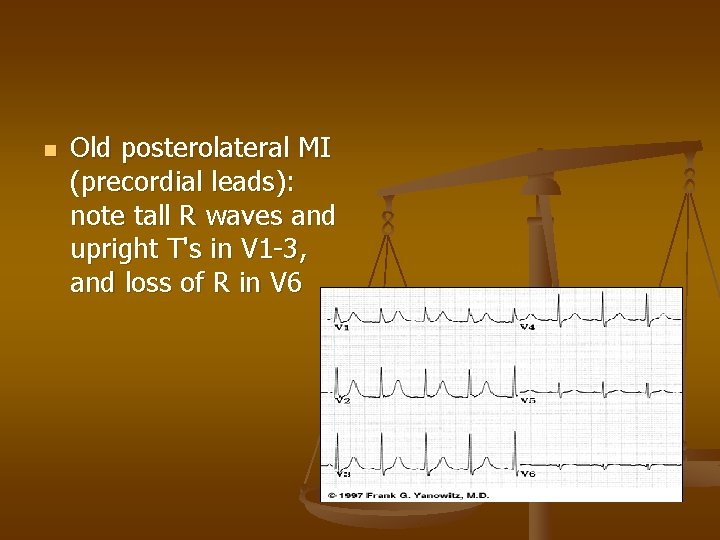 n Old posterolateral MI (precordial leads): note tall R waves and upright T's in
