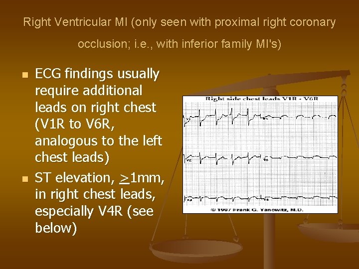 Right Ventricular MI (only seen with proximal right coronary occlusion; i. e. , with