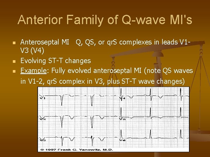 Anterior Family of Q-wave MI's n n n Anteroseptal MI Q, QS, or qr.