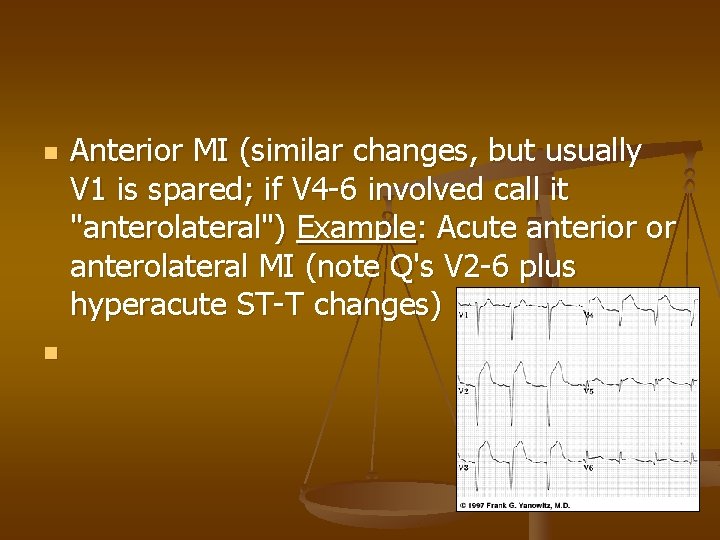 n n Anterior MI (similar changes, but usually V 1 is spared; if V