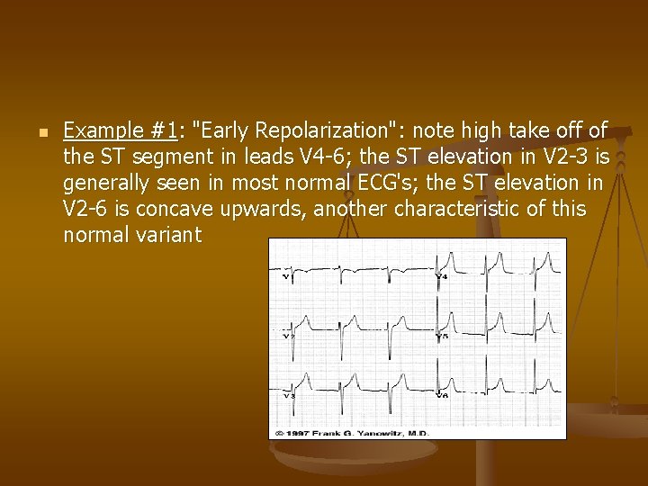 n Example #1: "Early Repolarization": note high take off of the ST segment in