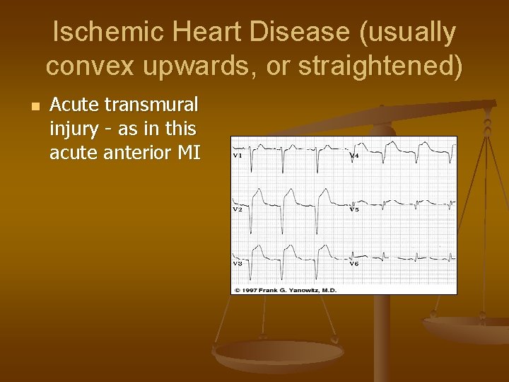 Ischemic Heart Disease (usually convex upwards, or straightened) n Acute transmural injury - as