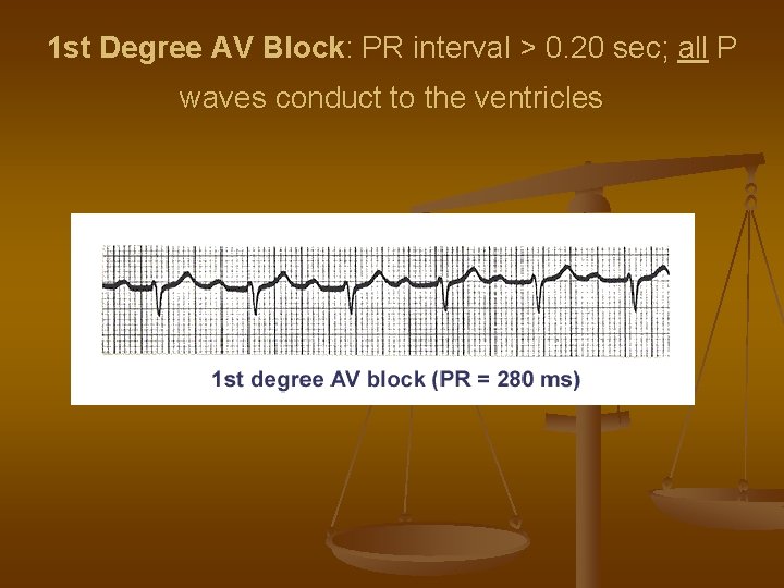 1 st Degree AV Block: PR interval > 0. 20 sec; all P waves