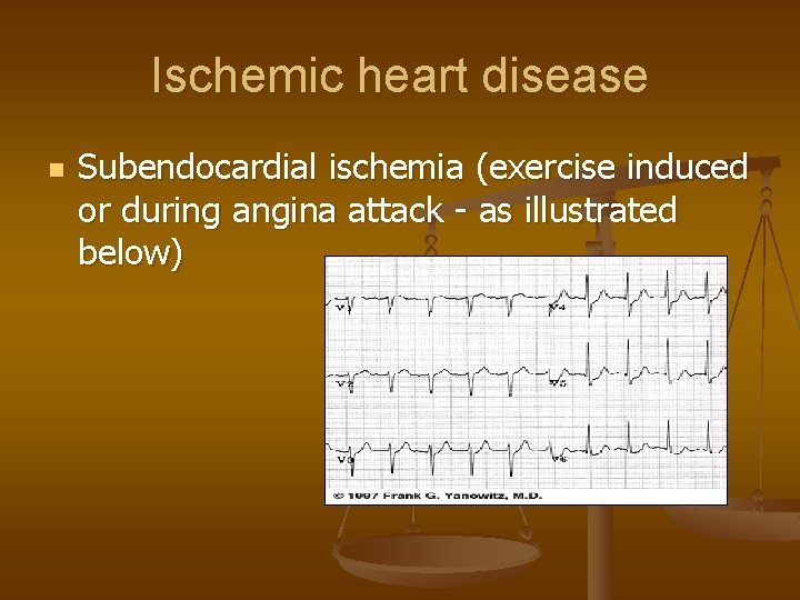 Ischemic heart disease n Subendocardial ischemia (exercise induced or during angina attack - as