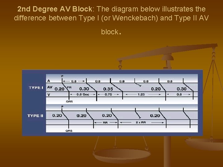 2 nd Degree AV Block: The diagram below illustrates the difference between Type I