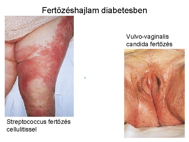 Fertőzéshajlam diabetesben Vulvo-vaginalis candida fertőzés Streptococcus fertőzés cellulitissel 