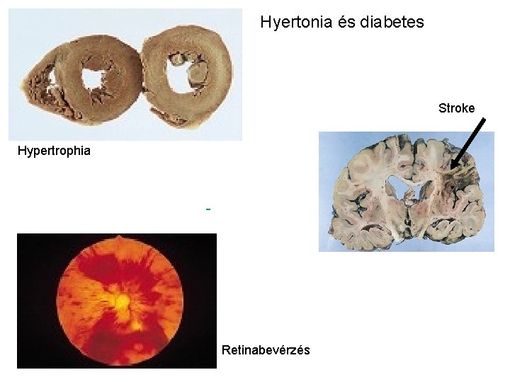Hyertonia és diabetes Stroke Hypertrophia Retinabevérzés 