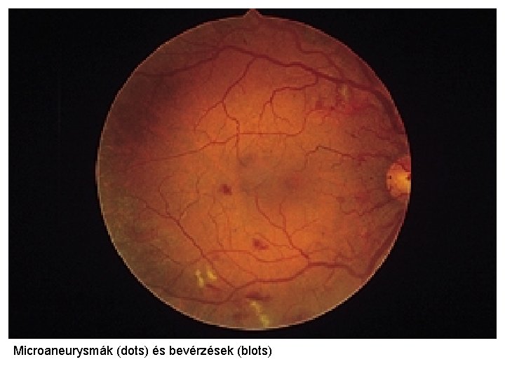 Microaneurysmák (dots) és bevérzések (blots) 