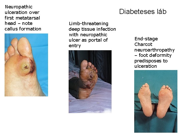 Neuropathic ulceration over first metatarsal head – note callus formation Diabeteses láb Limb-threatening deep