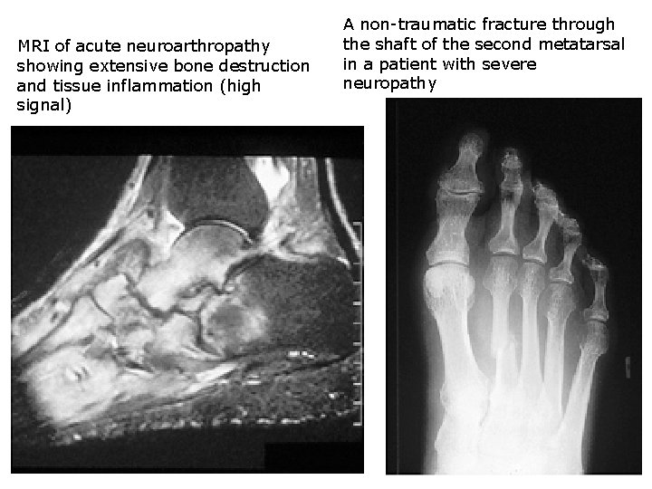 MRI of acute neuroarthropathy showing extensive bone destruction and tissue inflammation (high signal) A