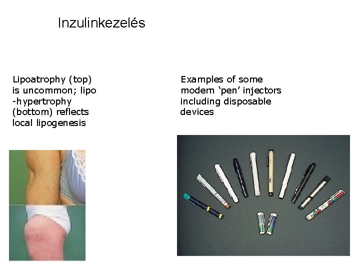 Inzulinkezelés Lipoatrophy (top) is uncommon; lipo -hypertrophy (bottom) reflects local lipogenesis Examples of some