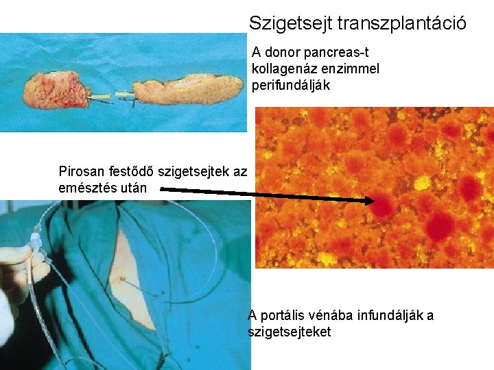 Szigetsejt transzplantáció A donor pancreas-t kollagenáz enzimmel perifundálják Pirosan festődő szigetsejtek az emésztés után