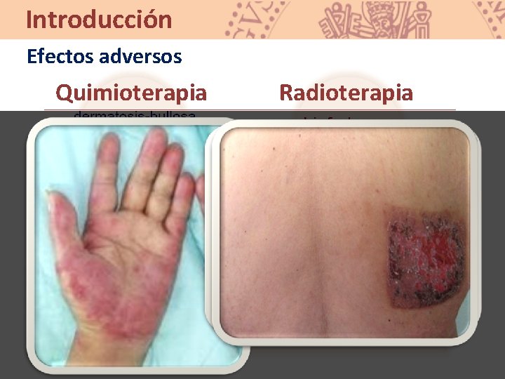 Introducción Efectos adversos Quimioterapia Radioterapia 