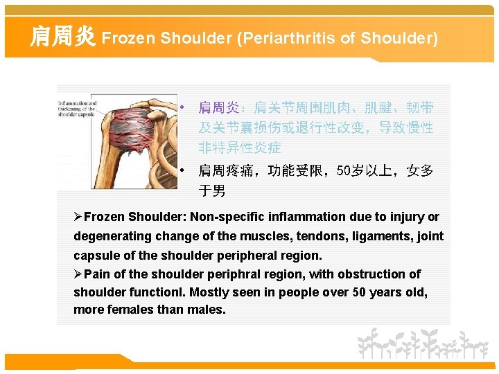 肩周炎 Frozen Shoulder (Periarthritis of Shoulder) • 肩周炎：肩关节周围肌肉、肌腱、韧带 及关节囊损伤或退行性改变，导致慢性 非特异性炎症 • 肩周疼痛，功能受限，50岁以上，女多 于男 ØFrozen