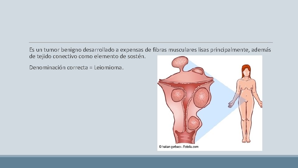 Es un tumor benigno desarrollado a expensas de fibras musculares lisas principalmente, además de