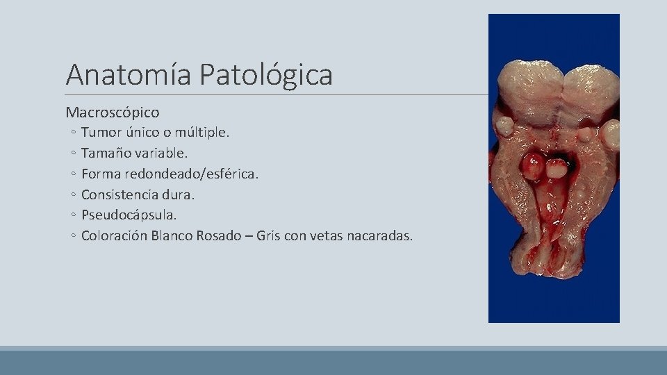 Anatomía Patológica Macroscópico ◦ Tumor único o múltiple. ◦ Tamaño variable. ◦ Forma redondeado/esférica.