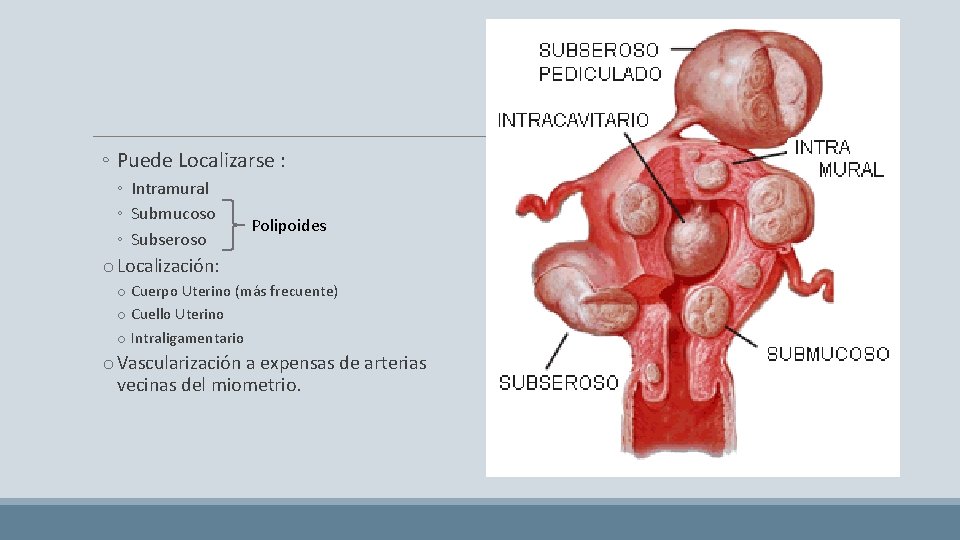 ◦ Puede Localizarse : ◦ Intramural ◦ Submucoso ◦ Subseroso Polipoides o Localización: o