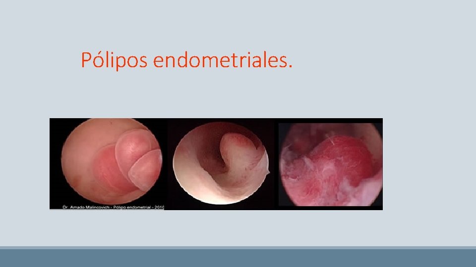 Pólipos endometriales. 