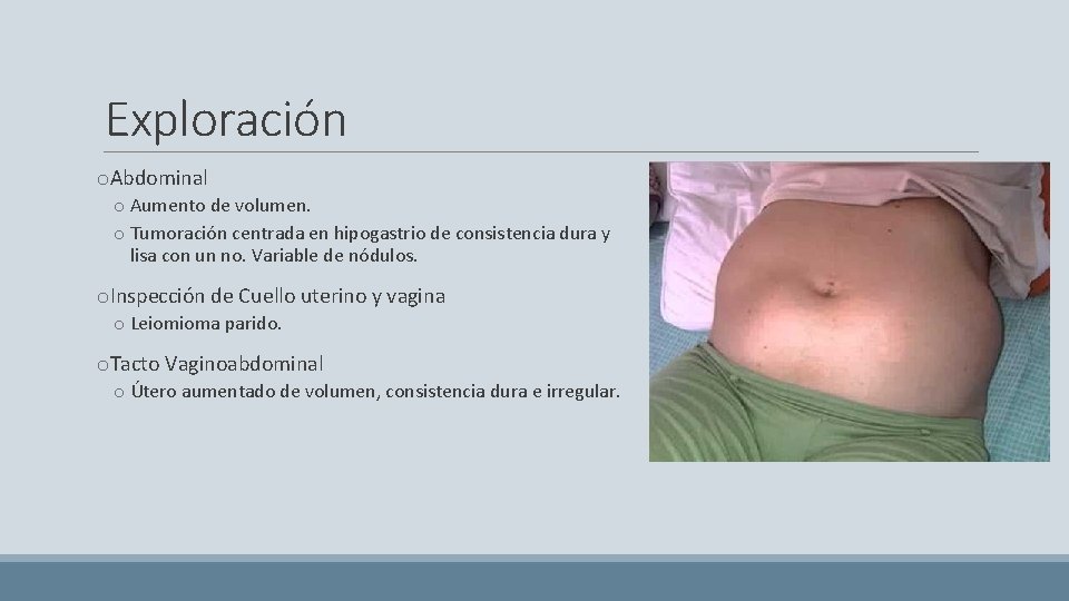 Exploración o. Abdominal o Aumento de volumen. o Tumoración centrada en hipogastrio de consistencia