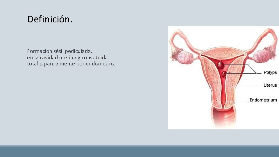 Definición. Formación sésil pediculada, en la cavidad uterina y constituida total o parcialmente por