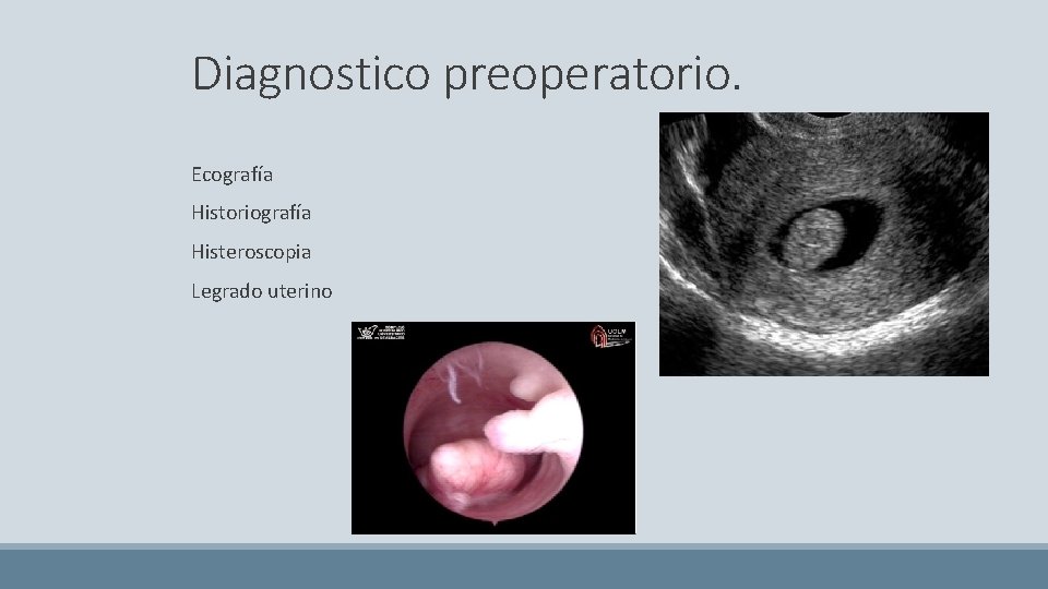 Diagnostico preoperatorio. Ecografía Historiografía Histeroscopia Legrado uterino 