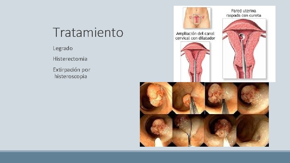 Tratamiento Legrado Histerectomia Extirpación por histeroscopia 