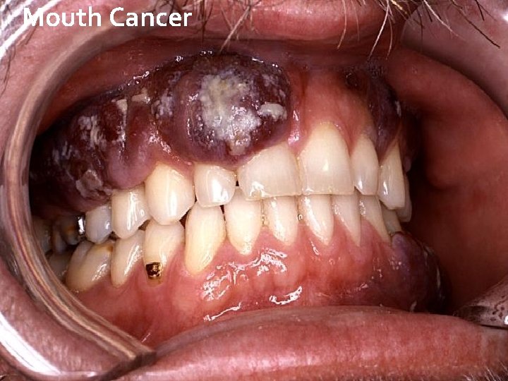 Mouth Cancer 