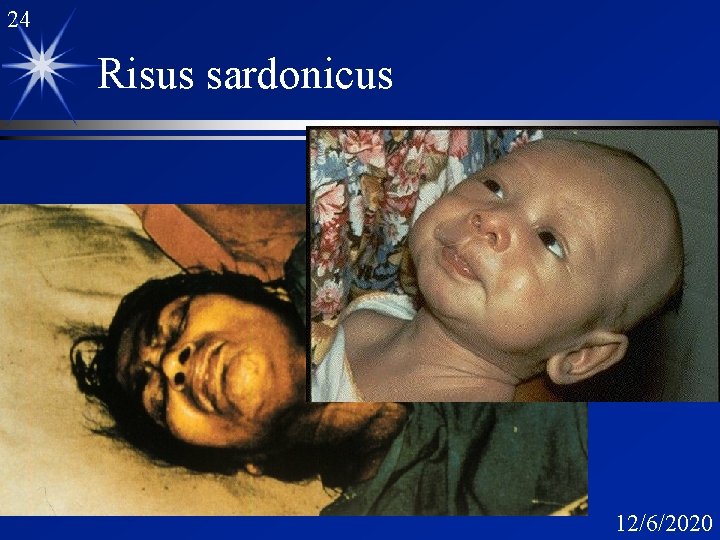 24 Risus sardonicus 12/6/2020 