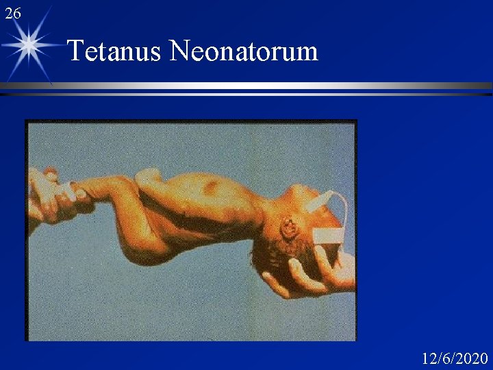 26 Tetanus Neonatorum 12/6/2020 