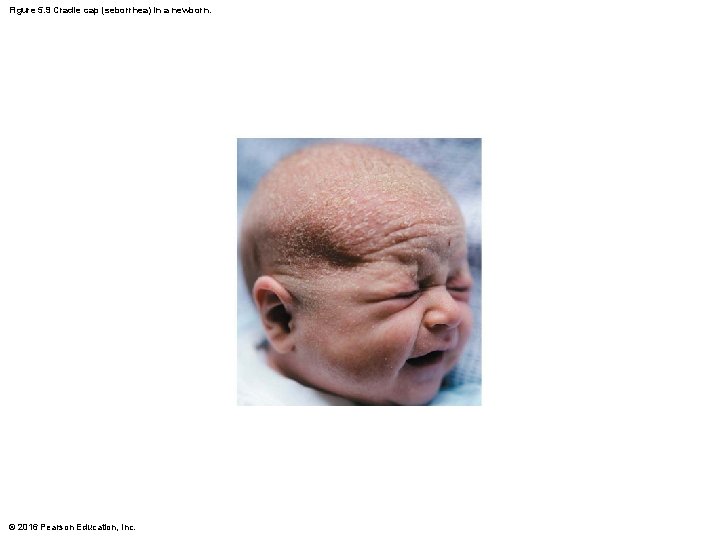 Figure 5. 9 Cradle cap (seborrhea) in a newborn. © 2016 Pearson Education, Inc.