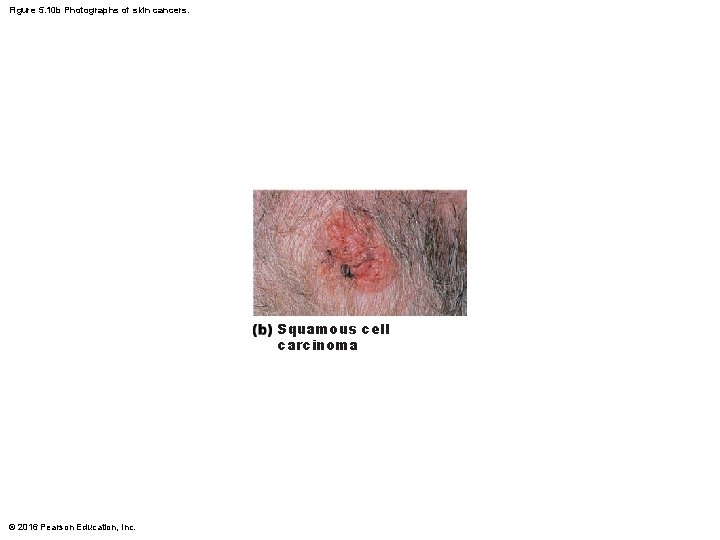 Figure 5. 10 b Photographs of skin cancers. Squamous cell carcinoma © 2016 Pearson