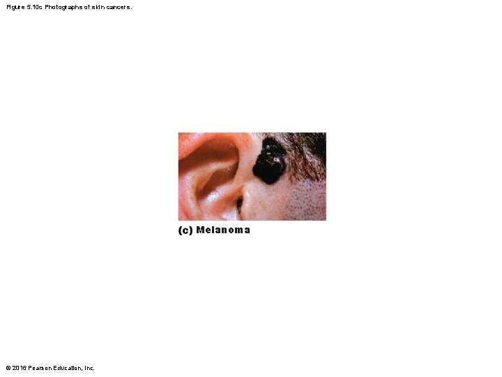 Figure 5. 10 c Photographs of skin cancers. Melanoma © 2016 Pearson Education, Inc.