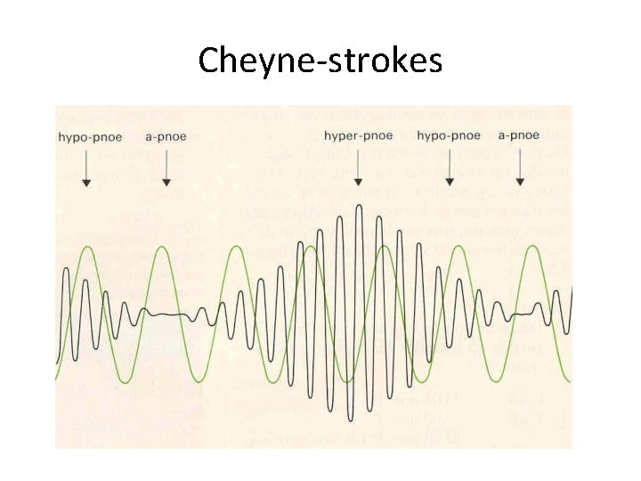 Cheyne-strokes Cheyne-strokes