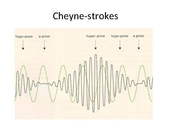 Cheyne-strokes 