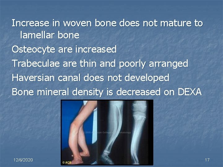 Increase in woven bone does not mature to lamellar bone Osteocyte are increased Trabeculae