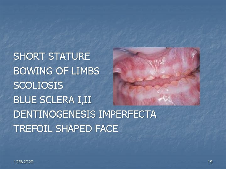 SHORT STATURE BOWING OF LIMBS SCOLIOSIS BLUE SCLERA I, II DENTINOGENESIS IMPERFECTA TREFOIL SHAPED