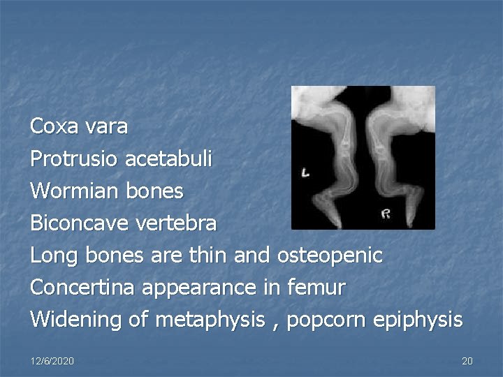 Coxa vara Protrusio acetabuli Wormian bones Biconcave vertebra Long bones are thin and osteopenic