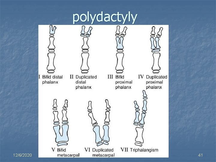 polydactyly 12/6/2020 41 
