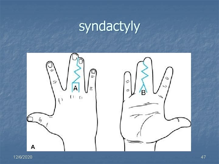 syndactyly 12/6/2020 47 