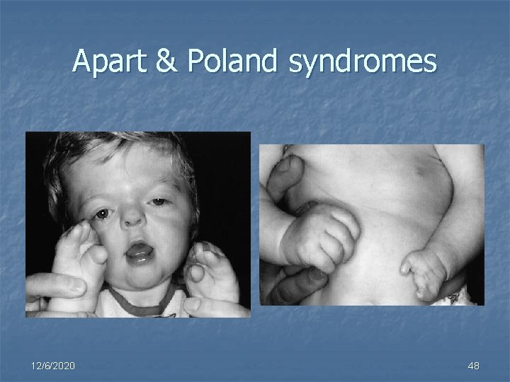Apart & Poland syndromes 12/6/2020 48 
