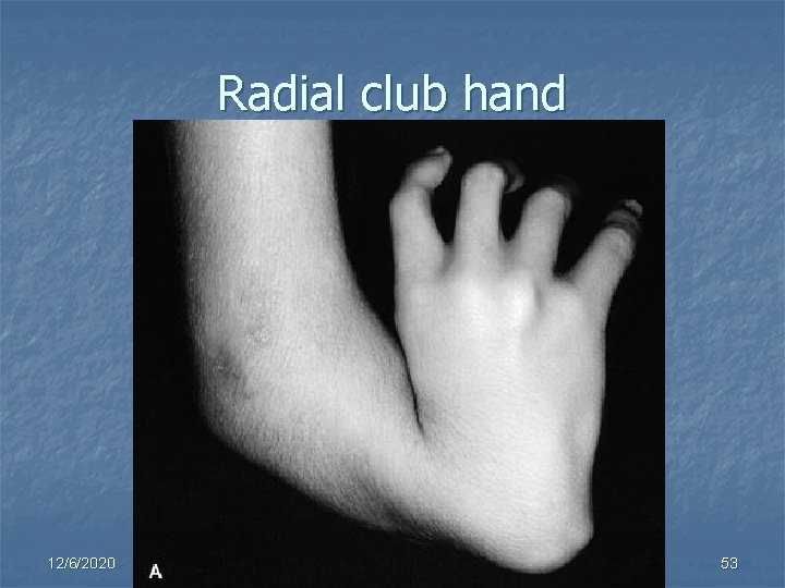 Radial club hand 12/6/2020 53 