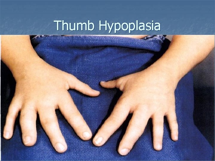  Thumb Hypoplasia 12/6/2020 62 